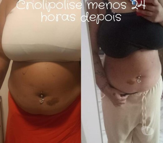 curso-criolipolise-anhembi-sp-cursos-no-328785305-big-0